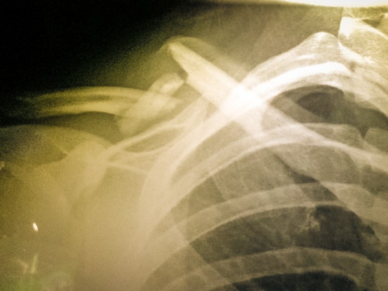 This is a common injury for mountain bikers, but nobody wants to be on the end of an X-Ray like this!  
