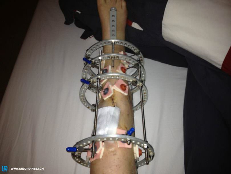 One of the many cages fitted to strengthen the leg.